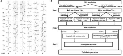 A Systemic Mapping Approach for Right and Left Parahisian Ventricular Arrhythmias Ablation